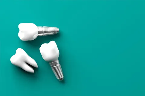 Dental Implants